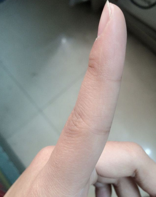为什么每个人食指都有疤 食指疤痕代表什么意思