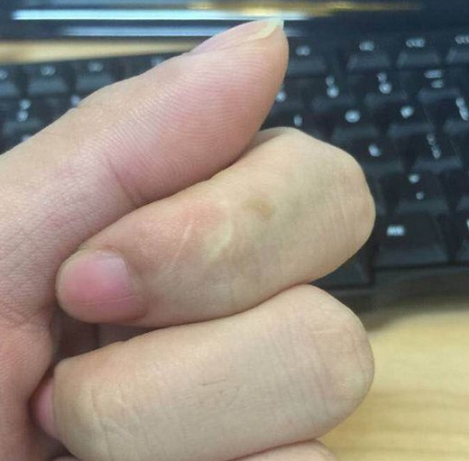 为什么每个人食指都有疤 食指疤痕代表什么意思
